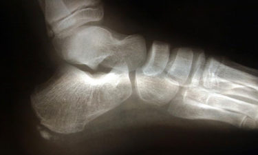 3 natural treatments for heel spur relief