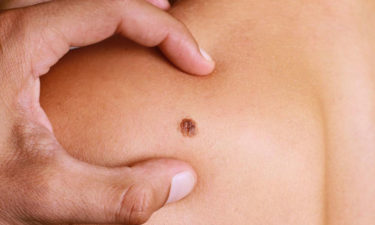 4 common types of melanoma and their treatment options