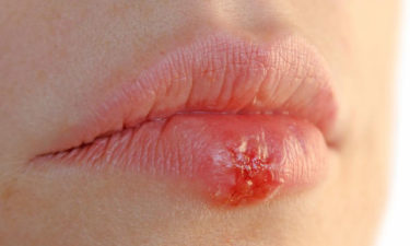 4 effective home remedies for herpes