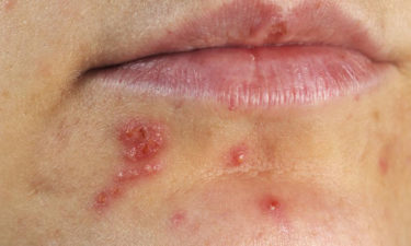 4 effective ways to treat herpes