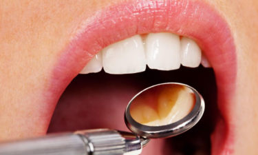 4 myths about dental implants busted