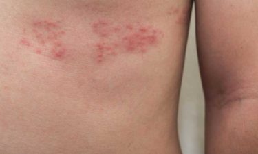 5 Ways to Deal with Shingles Nerve Pain