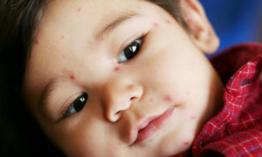 5 tell-tale signs of chickenpox you should know about
