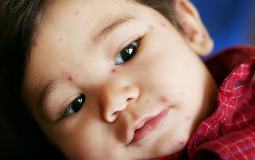 5 tell-tale signs of chickenpox you should know about