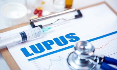 5 things to know about Lupus