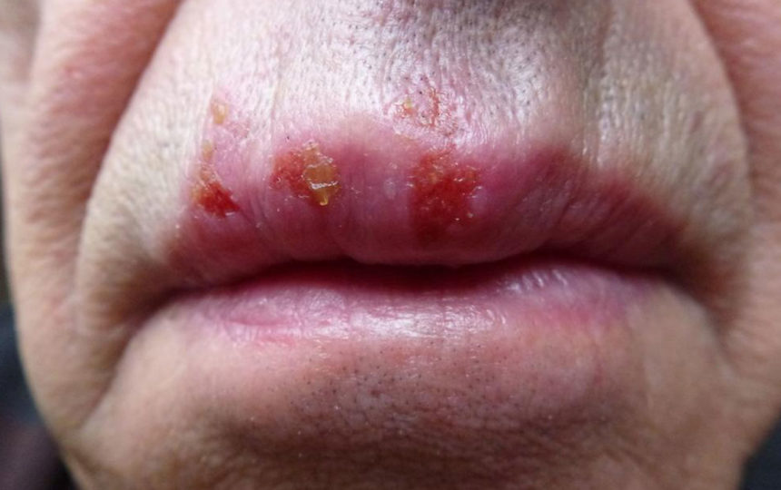 7 myths about herpes