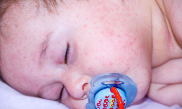 8 ways to take care of atopic dermatitis in kids