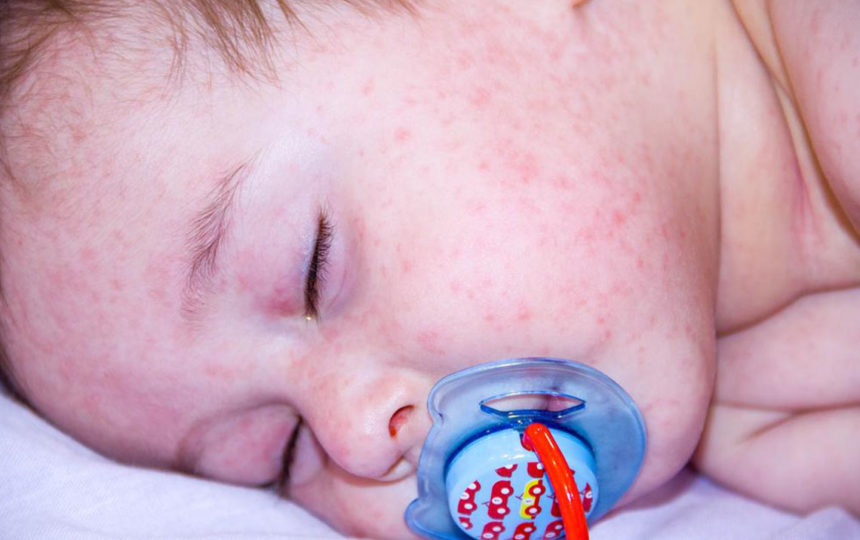 8 ways to take care of atopic dermatitis in kids