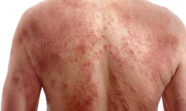 A few quick ways to identify chickenpox infection