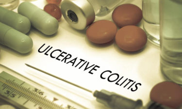 An overview for the treatment of Ulcerative Colitis