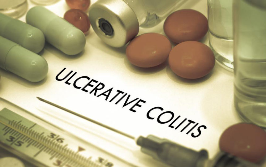 An overview for the treatment of Ulcerative Colitis