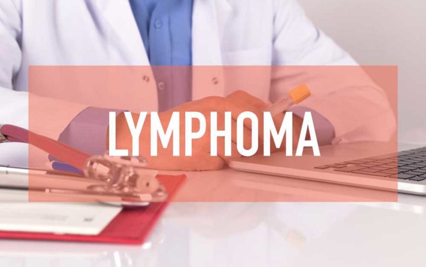 Best Treatment Options for Non Hodgkin Lymphoma