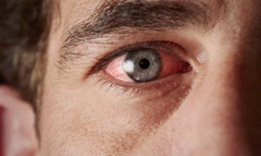 Common Causes of Blood Vessel Burst in the Eye
