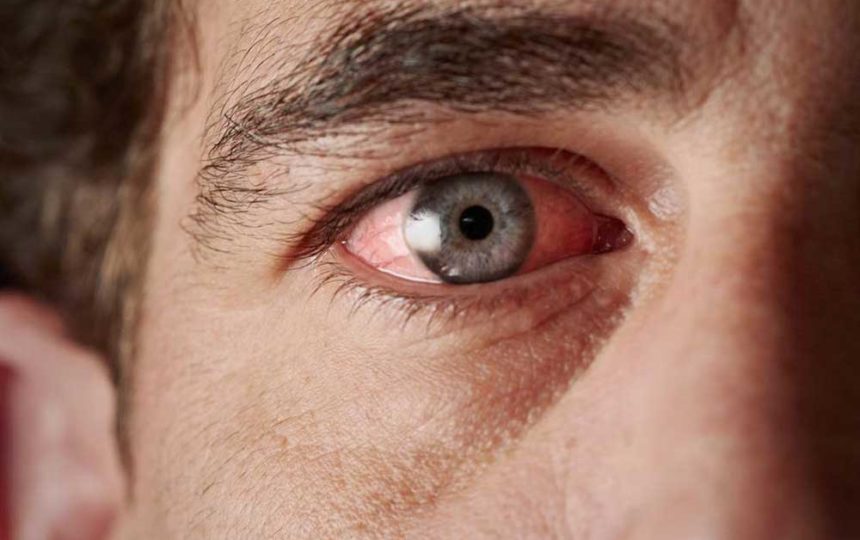 Common Causes of Blood Vessel Burst in the Eye