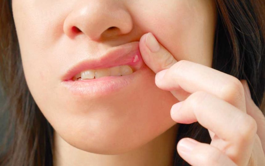 Common Reasons for Sores in the Mouth