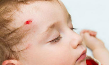 Common head injury symptoms in adults and children