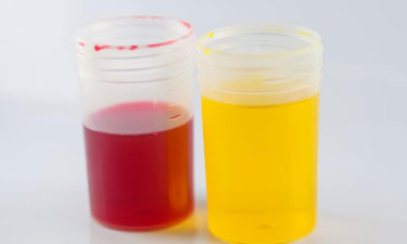 Definition, causes and symptoms of urine color