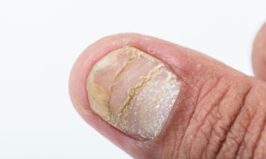 Different types of nail diseases and their causes