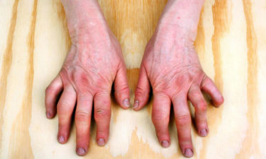 Do you have psoriatic arthritis symptoms
