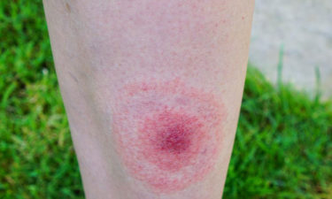 Early signs of lyme disease