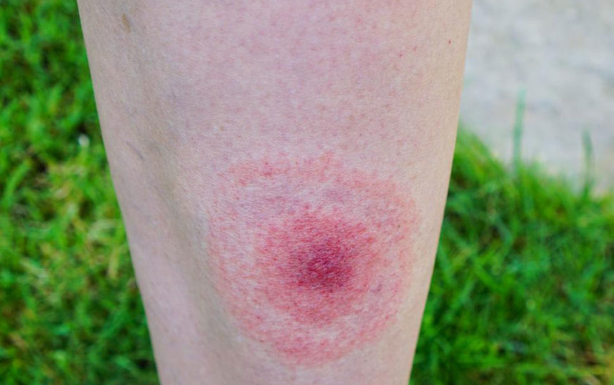 Early signs of lyme disease