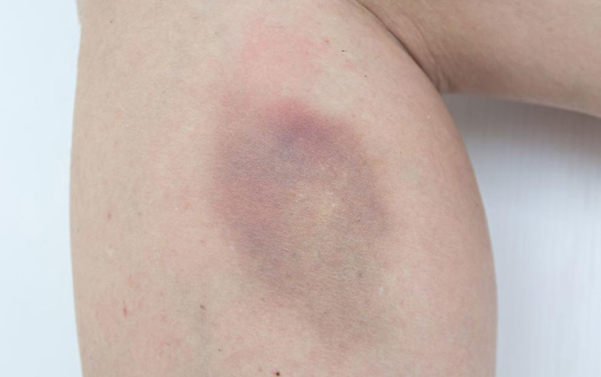 Easy bruising – Causes and treatments
