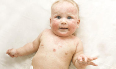 Everything you need to know about atopic dermatitis
