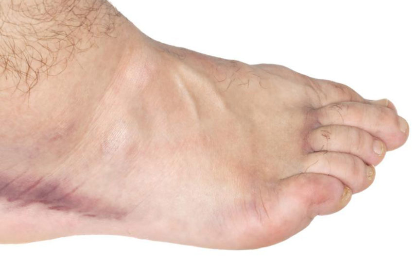 Exercises for swollen ankles treatment