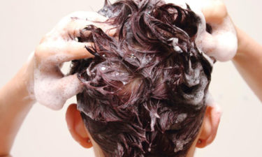 Five amazing home remedies for treating seborrheic dermatitis on scalp