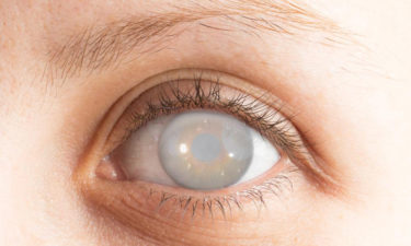 Five facts to know about cataract and its surgery