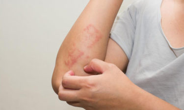 Here’s all that you need to know about scabies skin rash