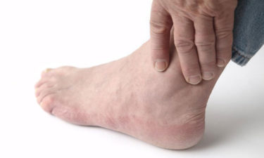 Home treatment for relief from gout foot pain