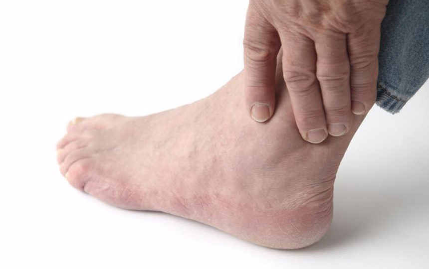 Home treatment for relief from gout foot pain