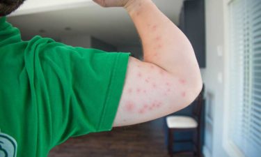 How to Identify and Treat Bedbug Bites