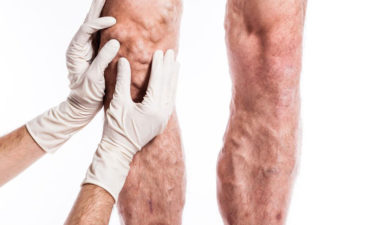 How to identify deep vein thrombosis at an early stage