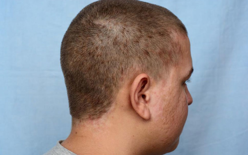 How to treat seborrheic dermatitis on the scalp