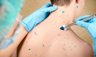 Identifying skin rashes and its treatments options