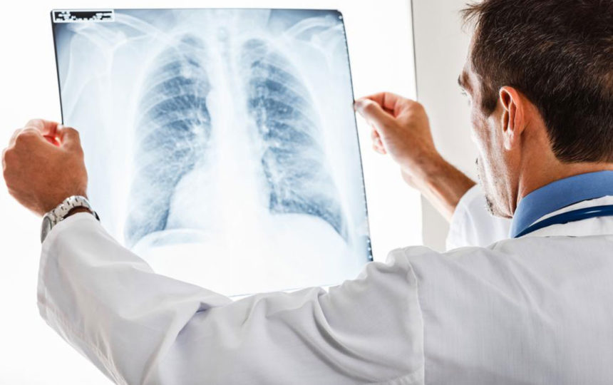 Know all about pulmonary embolisms