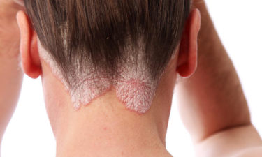 Know the skin ailment: Scalp psoriasis