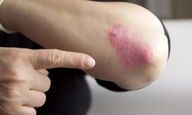 Moderate to severe plaque psoriasis treatment