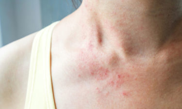 Mycosis fungoides – more than just a skin rash