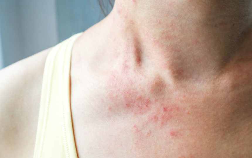 Mycosis fungoides – more than just a skin rash