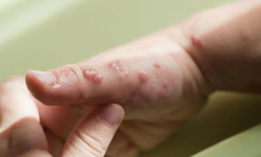 Nerves could be at risk due to shingles