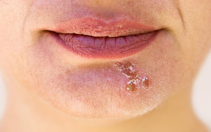 Popular essential oils to bid goodbye to cold sores
