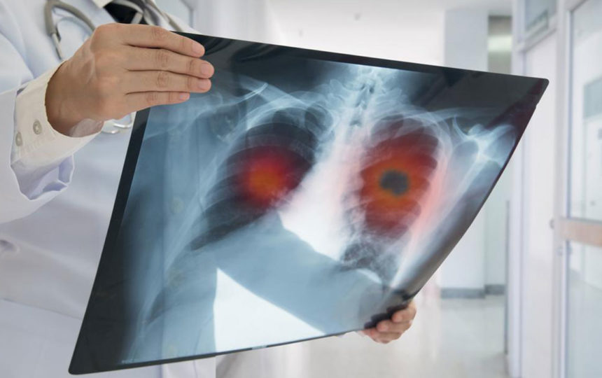 Popular treatment options for metastatic lung cancer