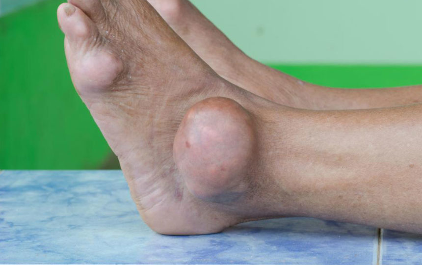 Preventive care for dealing with gout foot pain