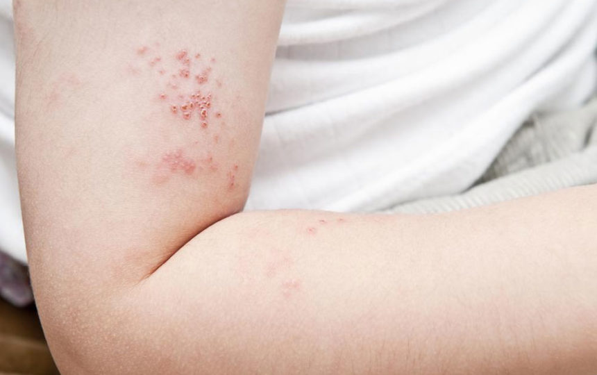 Prevent yourself from shingles before it infects you