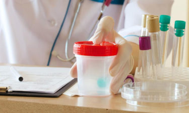 Proteinuria – The process of protein in urine test