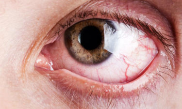 Signs that you might be experiencing dryness of your eyes