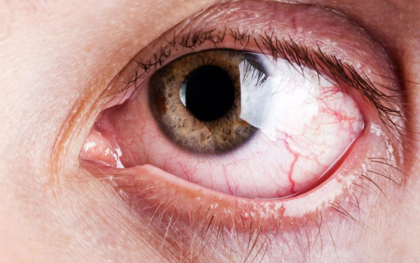 Signs that you might be experiencing dryness of your eyes